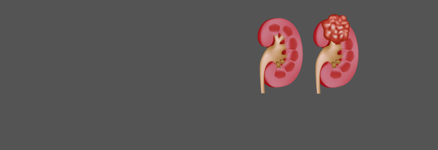 Kidney Cancer in India: All You Need to Know